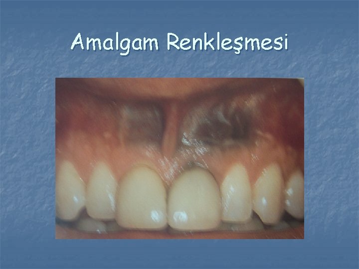 Amalgam Renkleşmesi Amalgam Renkleşmesi