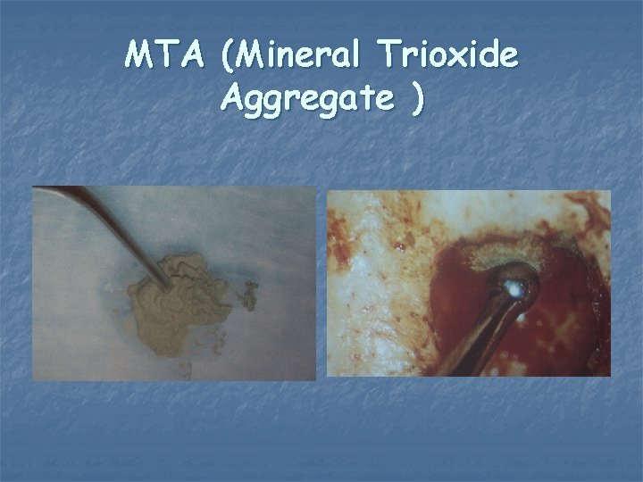MTA (Mineral Trioxide Aggregate ) MTA (Mineral Trioxide Aggregate )