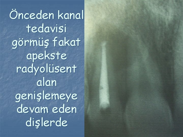 Önceden kanal tedavisi görmüş fakat apekste radyolüsent alan genişlemeye devam eden dişlerde Önceden kanal tedavisi görmüş fakat apekste radyolüsent alan genişlemeye devam eden dişlerde