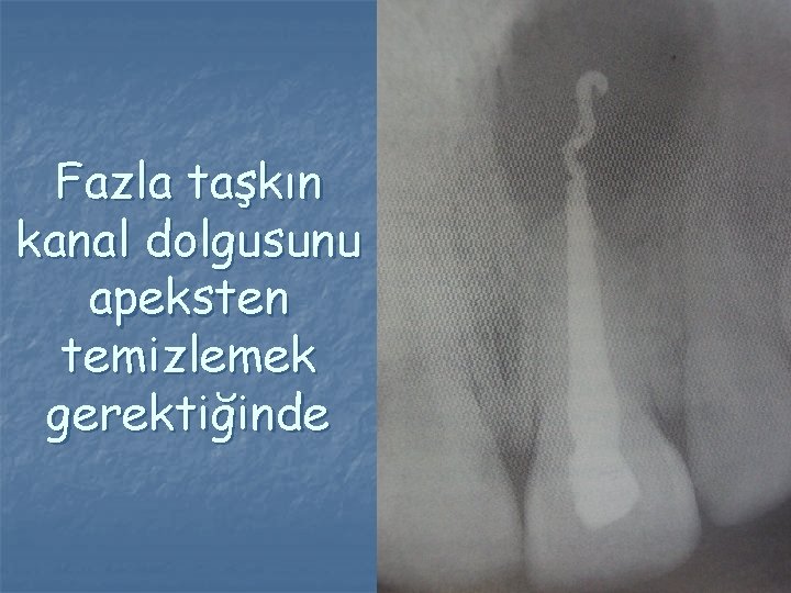 Fazla taşkın kanal dolgusunu apeksten temizlemek gerektiğinde Fazla taşkın kanal dolgusunu apeksten temizlemek gerektiğinde
