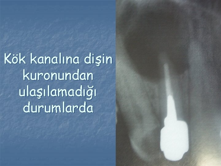 Kök kanalına dişin kuronundan ulaşılamadığı durumlarda Kök kanalına dişin kuronundan ulaşılamadığı durumlarda