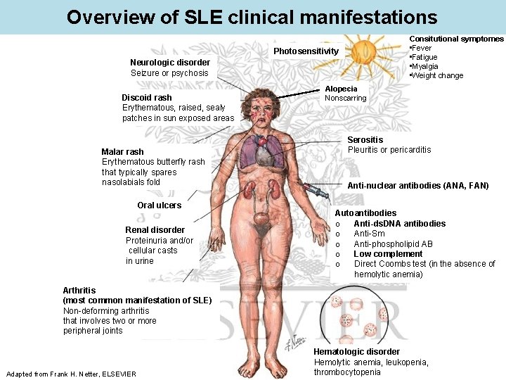 Overview of SLE clinical manifestations Consitutional symptomes • Fever • Fatigue • Myalgia •
