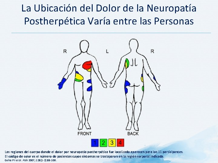 La Ubicación del Dolor de la Neuropatía Postherpética Varía entre las Personas Las regiones