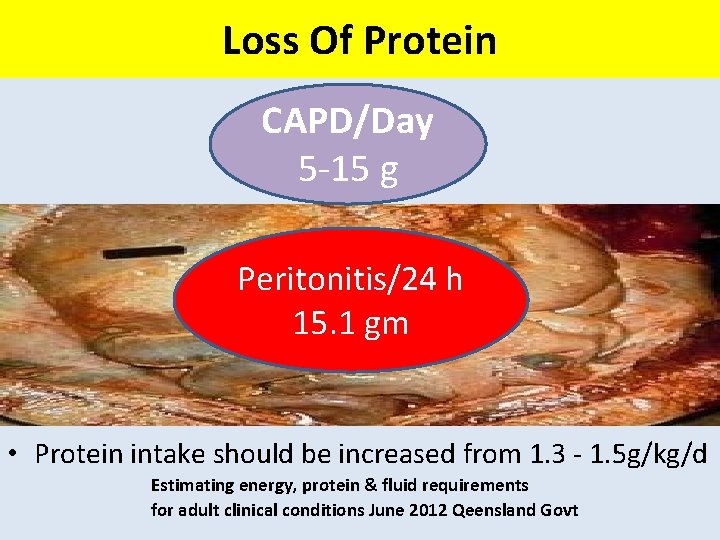 Loss Of Protein CAPD/Day 5 -15 g Peritonitis/24 h 15. 1 gm • Protein