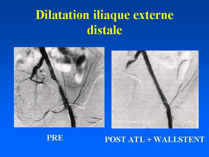 Dilatation iliaque externe distale PRE POST ATL + WALLSTENT 