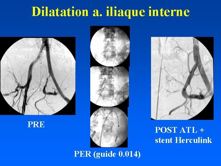 Dilatation a. iliaque interne PRE POST ATL + stent Herculink PER (guide 0. 014)