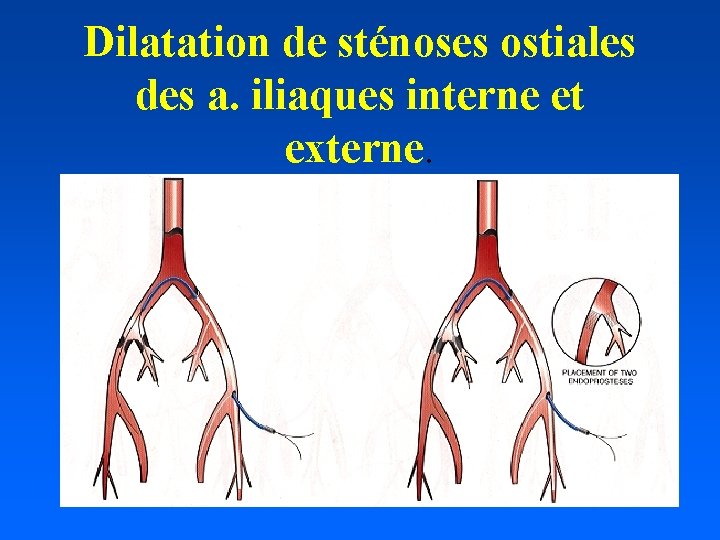 Dilatation de sténoses ostiales des a. iliaques interne et externe. 