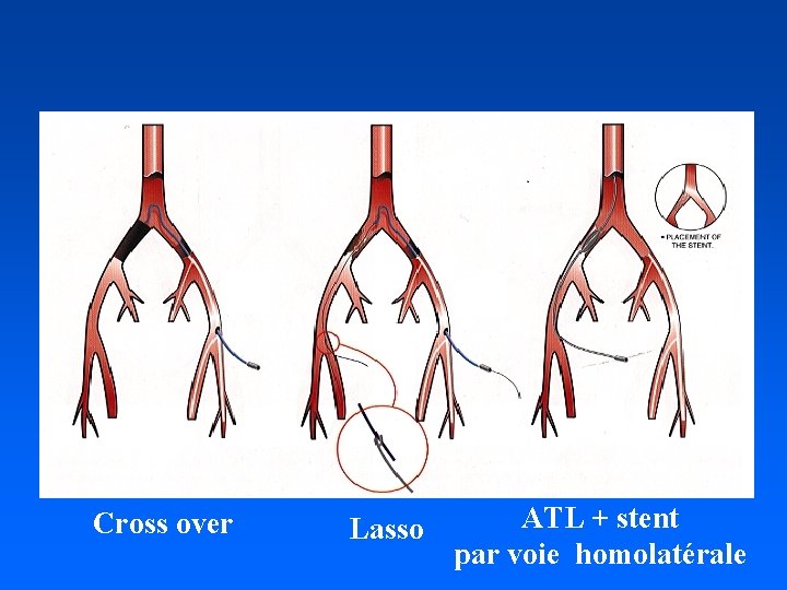 Cross over Lasso ATL + stent par voie homolatérale 