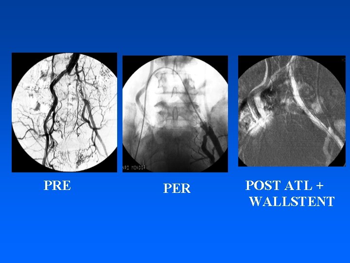 PRE PER POST ATL + WALLSTENT 
