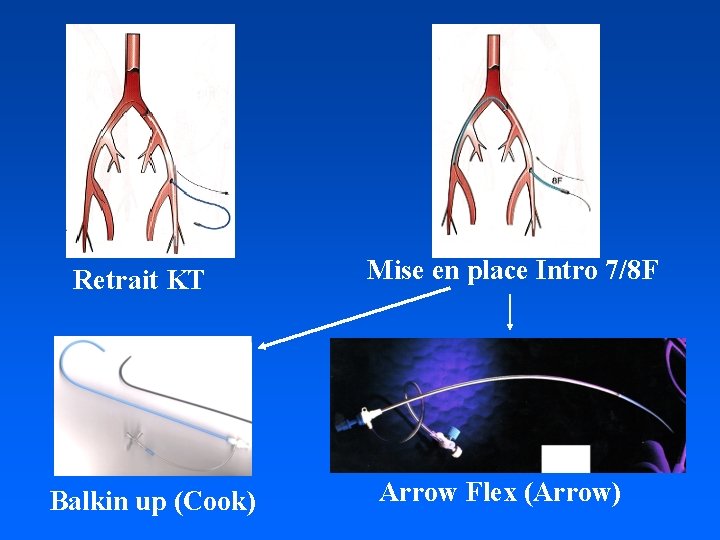 Retrait KT Balkin up (Cook) Mise en place Intro 7/8 F Arrow Flex (Arrow)