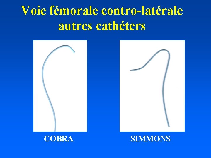 Voie fémorale contro-latérale autres cathéters COBRA SIMMONS 