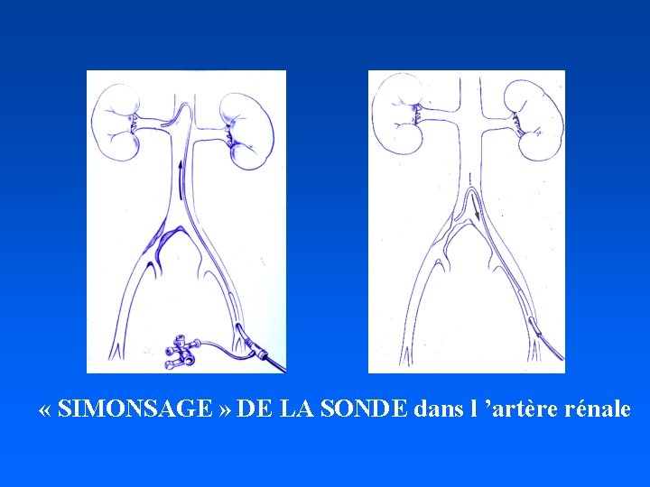  « SIMONSAGE » DE LA SONDE dans l ’artère rénale 