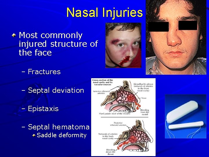 Nasal Injuries Most commonly injured structure of the face – Fractures – Septal deviation