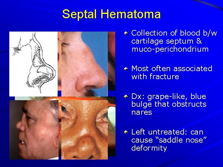 Septal Hematoma Collection of blood b/w cartilage septum & muco-perichondrium Most often associated with