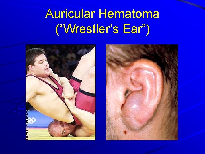 Auricular Hematoma (“Wrestler’s Ear”) 