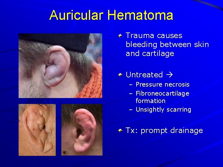 Auricular Hematoma Trauma causes bleeding between skin and cartilage Untreated – Pressure necrosis –