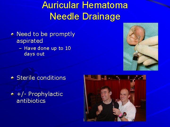 Auricular Hematoma Needle Drainage Need to be promptly aspirated – Have done up to