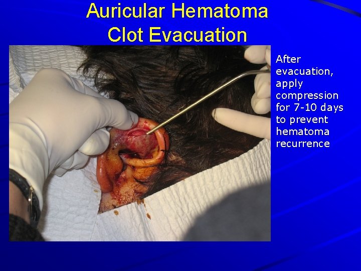 Auricular Hematoma Clot Evacuation After evacuation, apply compression for 7 -10 days to prevent