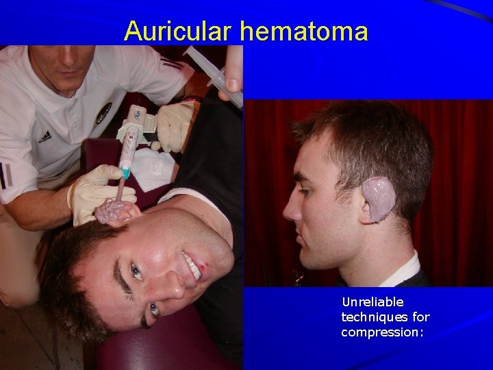 Auricular hematoma Unreliable techniques for compression: 