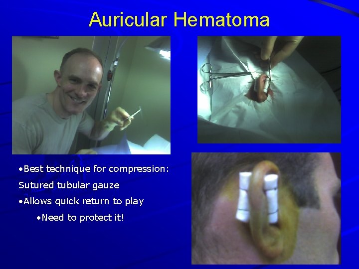 Auricular Hematoma • Best technique for compression: Sutured tubular gauze • Allows quick return