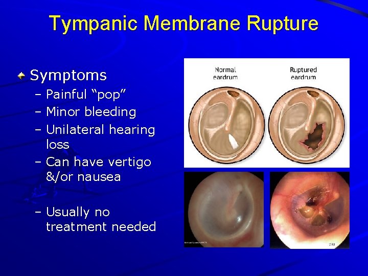 Tympanic Membrane Rupture Symptoms – Painful “pop” – Minor bleeding – Unilateral hearing loss