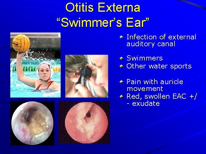 Otitis Externa “Swimmer’s Ear” Infection of external auditory canal Swimmers Other water sports Pain