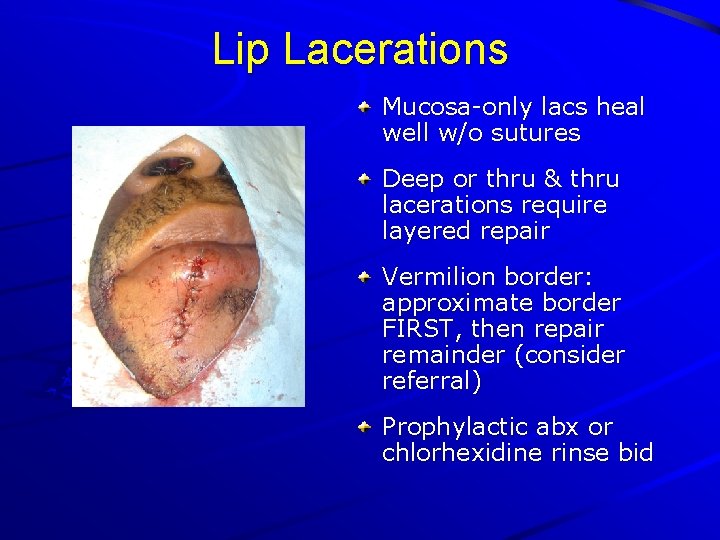 Lip Lacerations Mucosa-only lacs heal well w/o sutures Deep or thru & thru lacerations