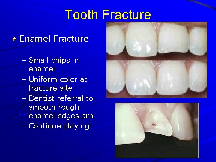 Tooth Fracture Enamel Fracture – Small chips in enamel – Uniform color at fracture