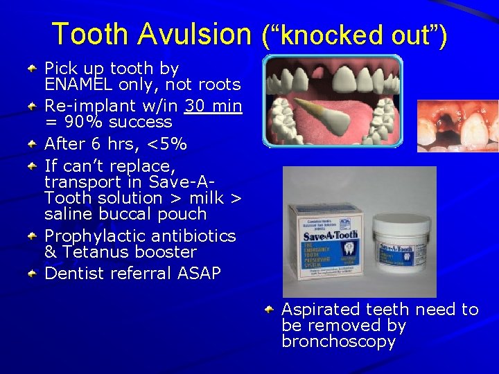 Tooth Avulsion (“knocked out”) Pick up tooth by ENAMEL only, not roots Re-implant w/in