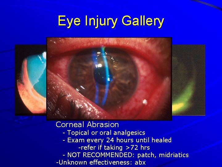 Eye Injury Gallery Corneal Abrasion - Topical or oral analgesics - Exam every 24