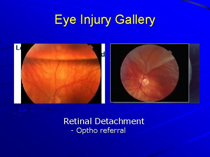 Eye Injury Gallery Retinal Detachment - Optho referral 