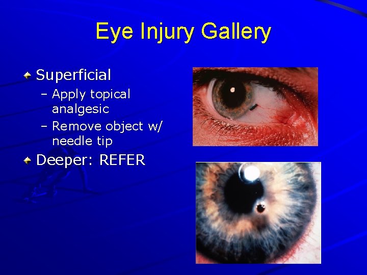 Eye Injury Gallery Superficial – Apply topical analgesic – Remove object w/ needle tip