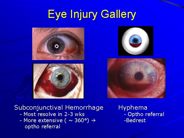 Eye Injury Gallery Subconjunctival Hemorrhage - Most resolve in 2 -3 wks - More