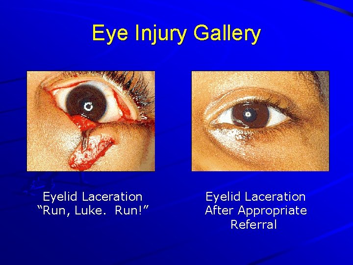Eye Injury Gallery Eyelid Laceration “Run, Luke. Run!” Eyelid Laceration After Appropriate Referral 