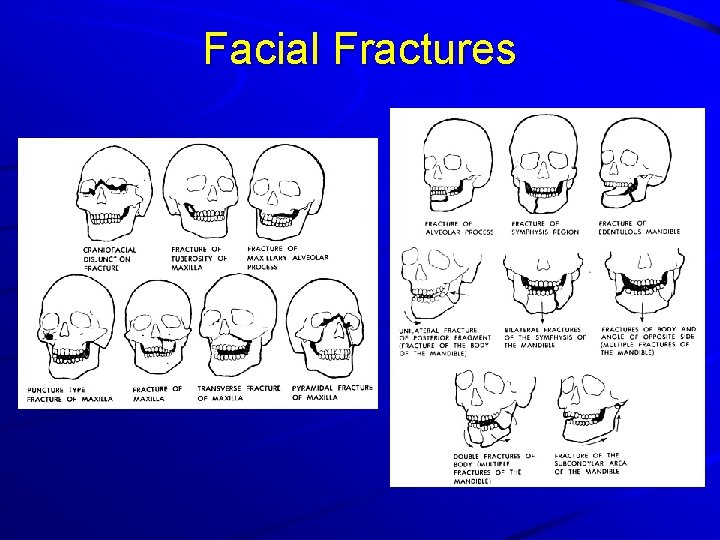 Facial Fractures 