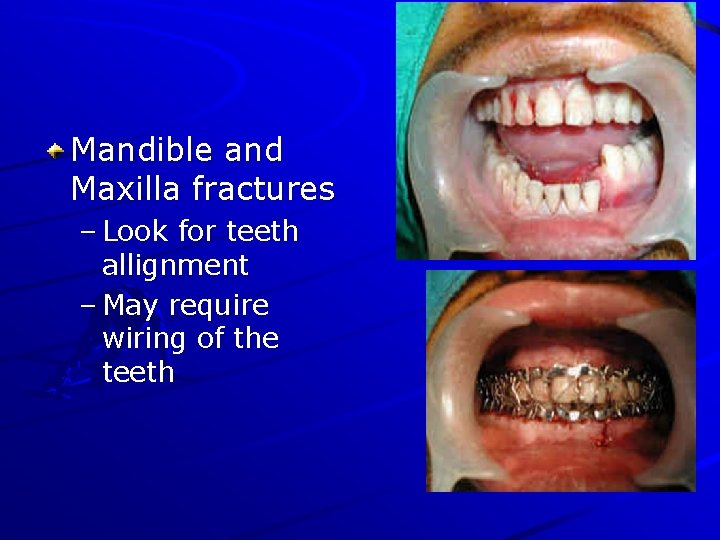 Mandible and Maxilla fractures – Look for teeth allignment – May require wiring of