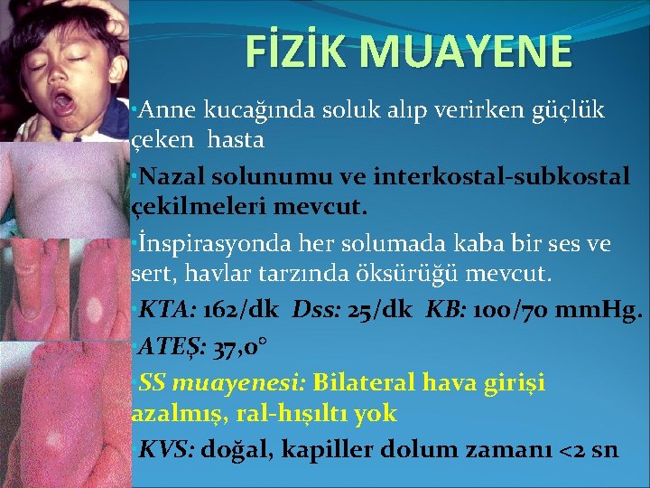 FİZİK MUAYENE • Anne kucağında soluk alıp verirken güçlük çeken hasta • Nazal solunumu