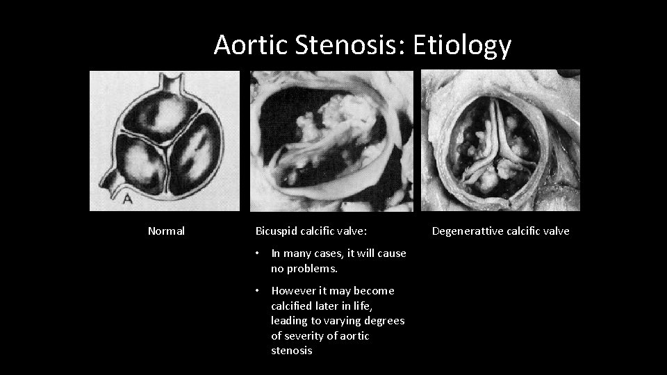 Aortic Stenosis: Etiology Normal Bicuspid calcific valve: • In many cases, it will cause