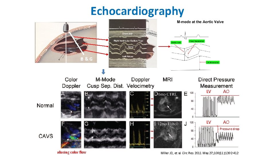 Echocardiography B&G LV AO 200 100 400 Pressure drop 200 aliasing color flow Miller