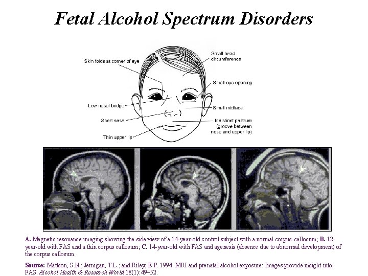 Fetal Alcohol Spectrum Disorders A. Magnetic resonance imaging showing the side view of a