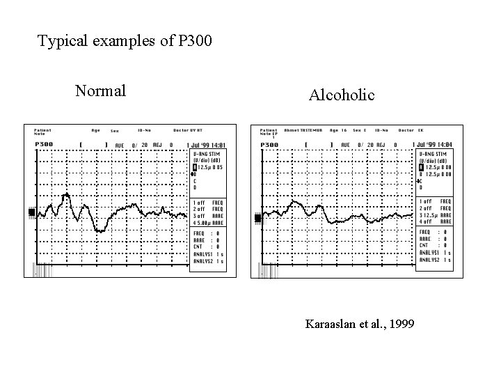 Typical examples of P 300 Normal Alcoholic Karaaslan et al. , 1999 