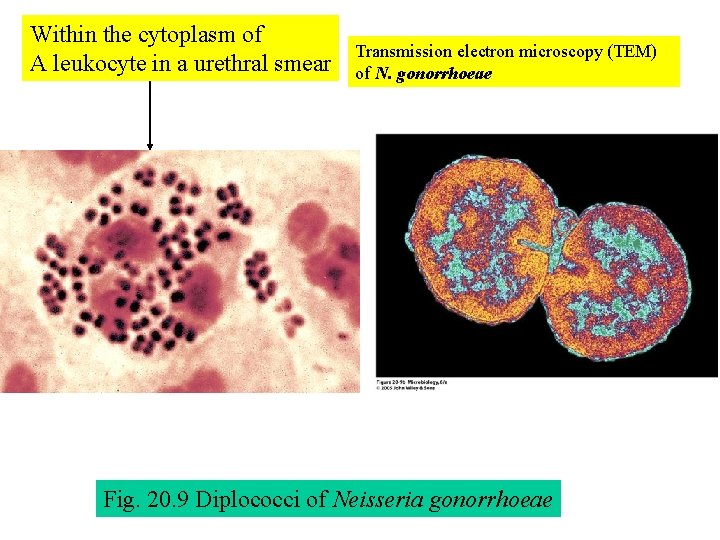 Within the cytoplasm of A leukocyte in a urethral smear Transmission electron microscopy (TEM)