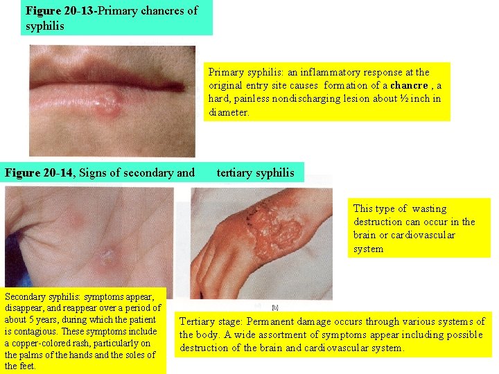 Figure 20 -13 -Primary chancres of syphilis Primary syphilis: an inflammatory response at the