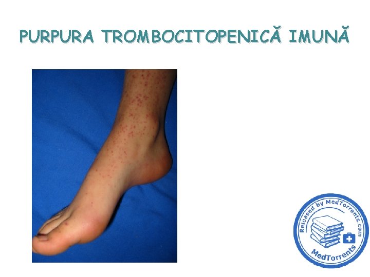 PURPURA TROMBOCITOPENICĂ IMUNĂ 1 