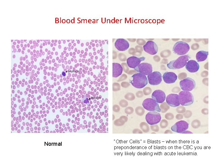 Blood Smear Under Microscope Normal “Other Cells” = Blasts – when there is a Blood Smear Under Microscope Normal “Other Cells” = Blasts – when there is a