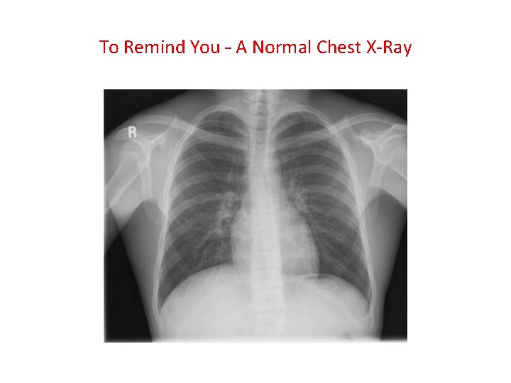 To Remind You – A Normal Chest X-Ray To Remind You – A Normal Chest X-Ray