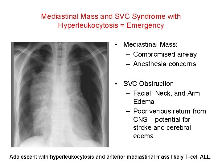 Mediastinal Mass and SVC Syndrome with Hyperleukocytosis = Emergency • Mediastinal Mass: – Compromised Mediastinal Mass and SVC Syndrome with Hyperleukocytosis = Emergency • Mediastinal Mass: – Compromised