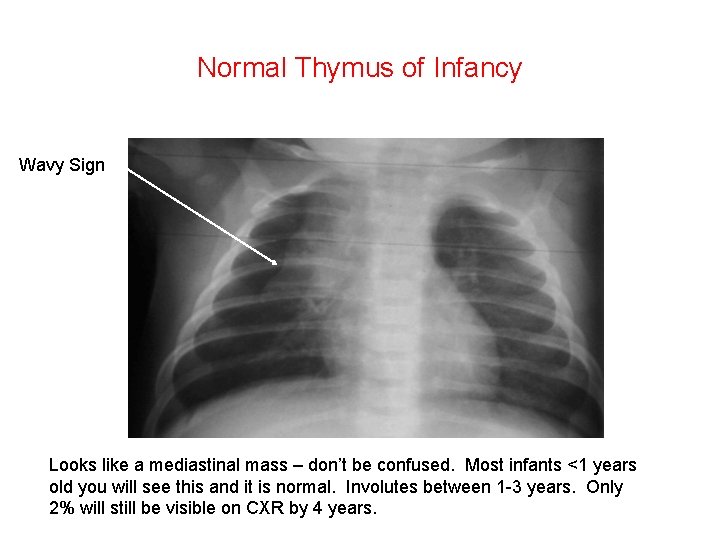 Normal Thymus of Infancy Wavy Sign Looks like a mediastinal mass – don’t be Normal Thymus of Infancy Wavy Sign Looks like a mediastinal mass – don’t be