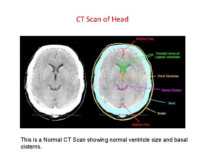 CT Scan of Head This is a Normal CT Scan showing normal ventricle size CT Scan of Head This is a Normal CT Scan showing normal ventricle size