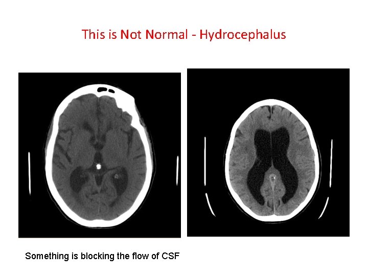 This is Not Normal - Hydrocephalus Something is blocking the flow of CSF This is Not Normal - Hydrocephalus Something is blocking the flow of CSF